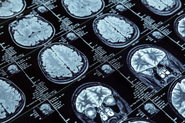 Vacina é a nova esperança contra tumores cerebrais